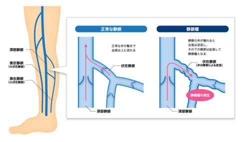 下肢静脈瘤とは 横浜血管クリニック