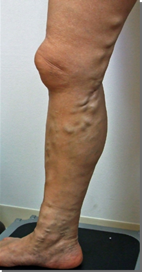 下肢静脈瘤とは 横浜血管クリニック